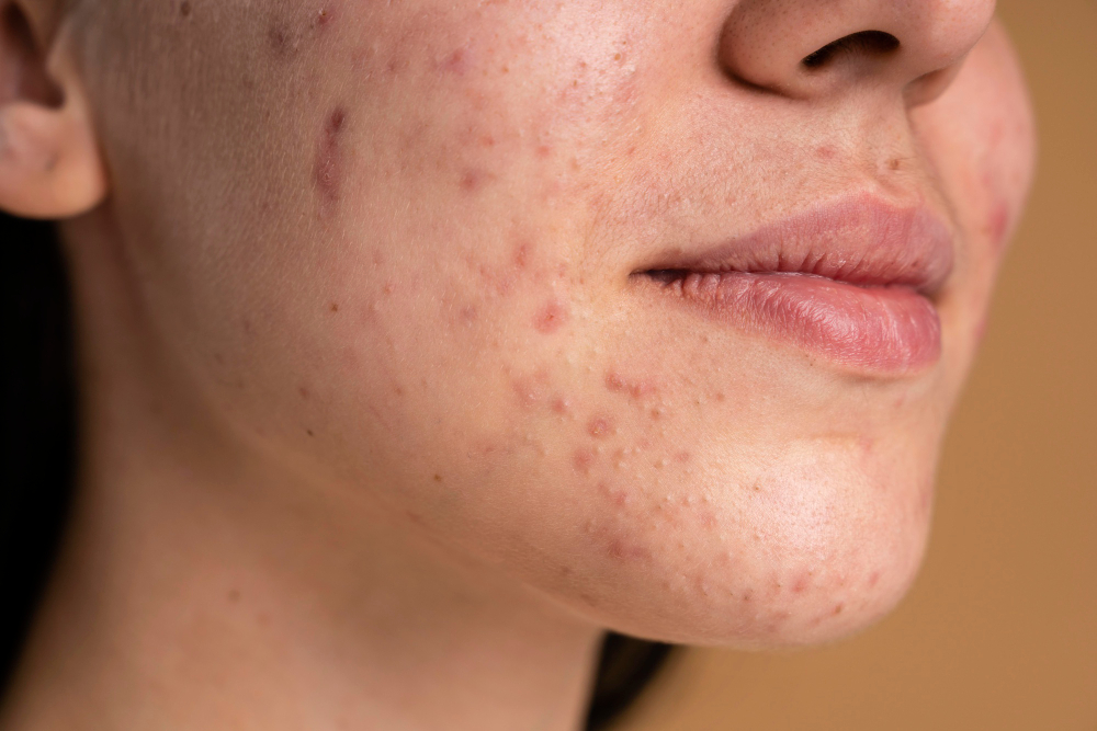 Primer plano de piel con granos antes del maquillaje